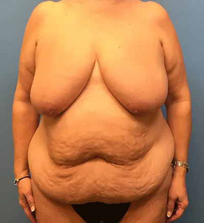 Mommy Makeover Case #39 — before, Dr. Samir Rao