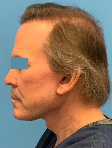 Facelift Case #23753 — after, Dr. Frank Albino