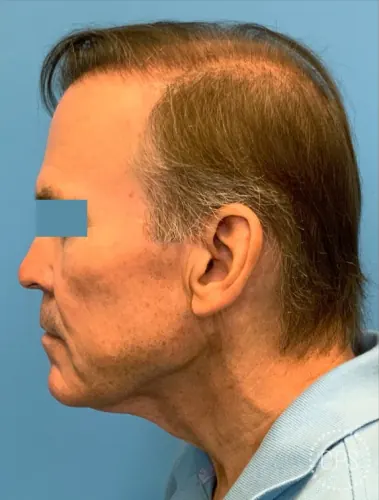Facelift Case #23753 — before, Dr. Frank Albino