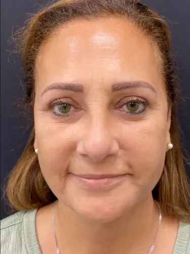 Neck Lift Case #4869 — after, Dr. Arjun Kanuri