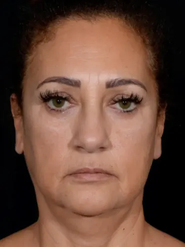 Neck Lift Case #4869 — before, Dr. Arjun Kanuri