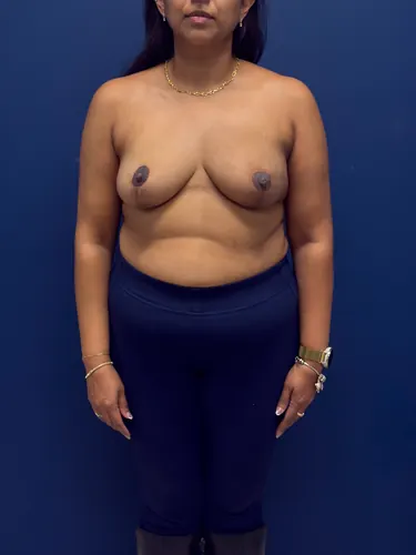 Breast Reconstruction Case #9659 — after, Dr. Samir Rao
