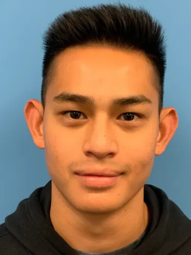 Otoplasty Case #2681 — before, Dr. Arjun Kanuri