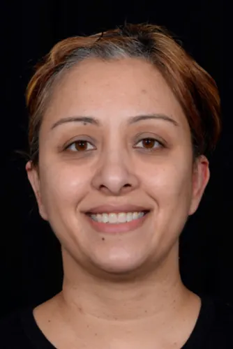 Otoplasty Case #4655 — after, Dr. Arjun Kanuri