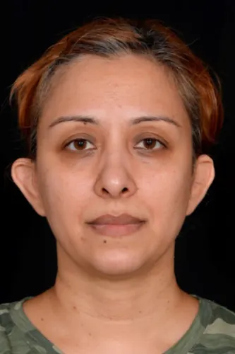 Otoplasty Case #4655 — before, Dr. Arjun Kanuri