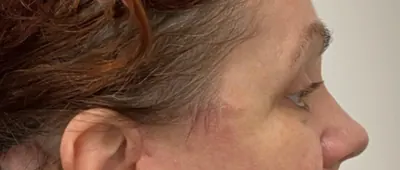 Eyelid Surgery Case #1851 — after, Dr. Arjun Kanuri