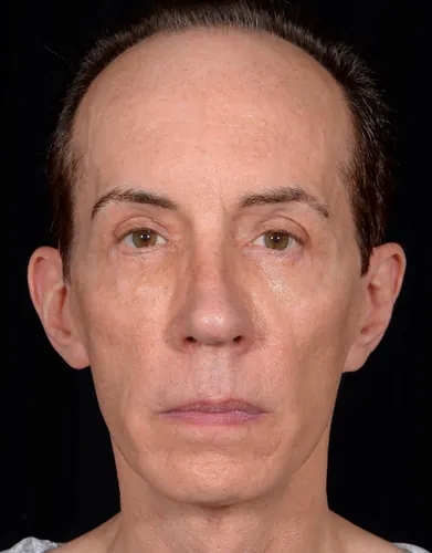 Eyelid Surgery Case #357 — after, Dr. Arjun Kanuri