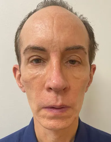 Eyelid Surgery Case #357 — before, Dr. Arjun Kanuri