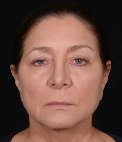 Eyelid Surgery Case #358 — before, Dr. Arjun Kanuri