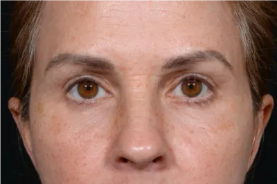Eyelid Surgery Case #5361 — after, Dr. Arjun Kanuri