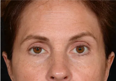 Eyelid Surgery Case #5361 — before, Dr. Arjun Kanuri