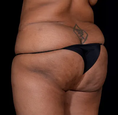 Brazilian Butt Lift (BBL) Case #352 — before, Dr. Arjun Kanuri