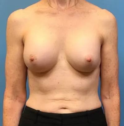 Revision Breast Augmentation Case #236 — before, Dr. Samir Rao