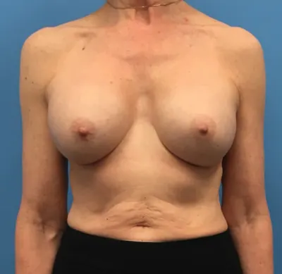 Revision Breast Augmentation Case #237 — after, Dr. Samir Rao