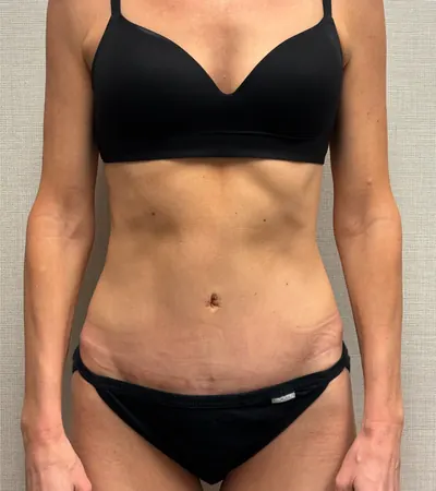 Tummy Tuck Case #23643 — after, Dr. Arjun Kanuri