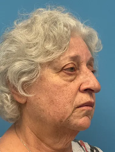 Rhinoplasty Case #25467 — before, Dr. Arjun Kanuri