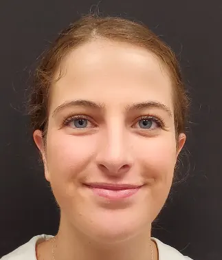 Rhinoplasty Case #381 — after, Dr. Arjun Kanuri