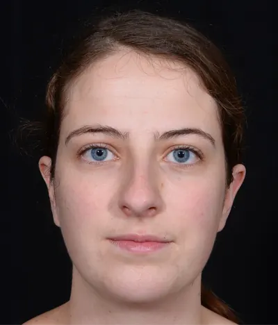 Rhinoplasty Case #381 — before, Dr. Arjun Kanuri