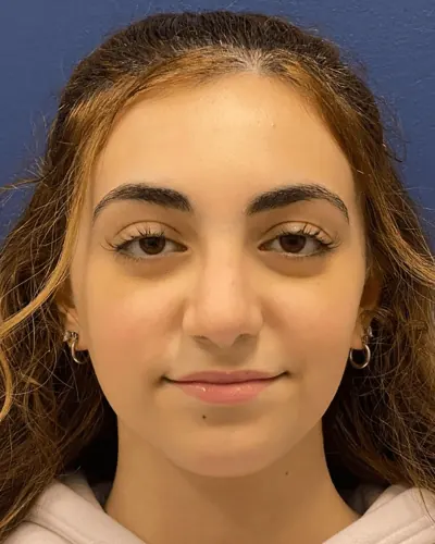 Rhinoplasty Case #23921 — after, Dr. Arjun Kanuri