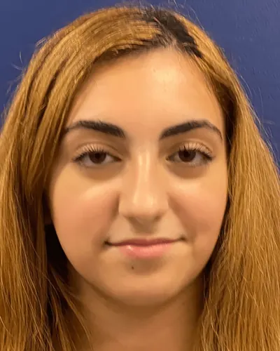 Rhinoplasty Case #23921 — before, Dr. Arjun Kanuri