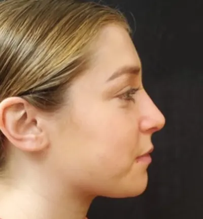 Rhinoplasty Case #374 — after, Dr. Arjun Kanuri