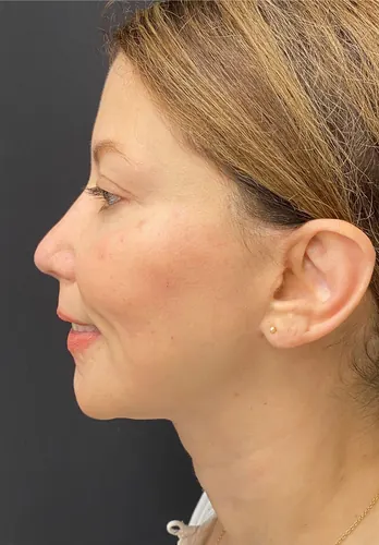 Rhinoplasty Case #375 — after, Dr. Arjun Kanuri