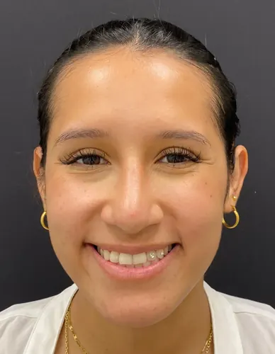 Rhinoplasty Case #376 — after, Dr. Arjun Kanuri