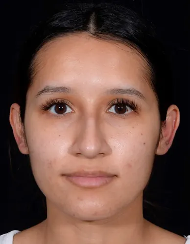 Rhinoplasty Case #376 — before, Dr. Arjun Kanuri