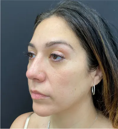 Rhinoplasty Case #377 — after, Dr. Arjun Kanuri