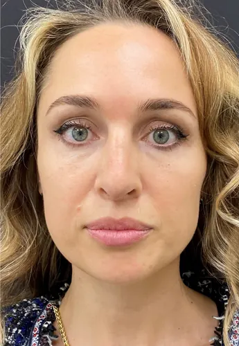 Rhinoplasty Case #378 — after, Dr. Arjun Kanuri