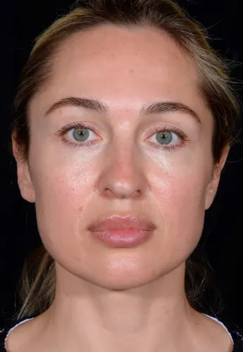 Rhinoplasty Case #378 — before, Dr. Arjun Kanuri