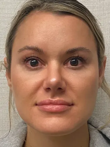 Rhinoplasty Case #4972 — after, Dr. Arjun Kanuri