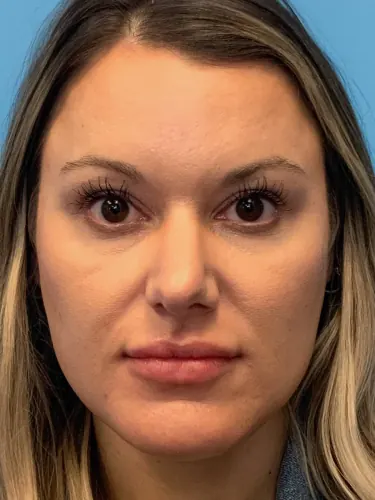 Rhinoplasty Case #4972 — before, Dr. Arjun Kanuri