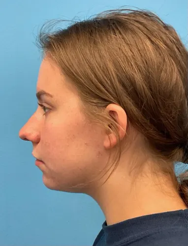 Rhinoplasty Case #23611 — before, Dr. Arjun Kanuri