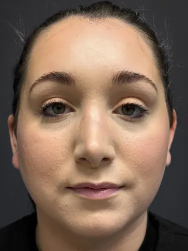 Submental Liposuction Case #3439 — after, Dr. Arjun Kanuri