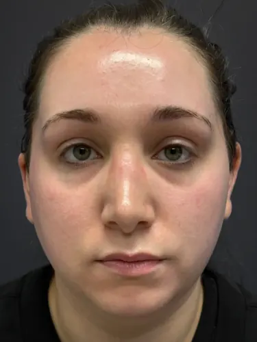 Submental Liposuction Case #3439 — before, Dr. Arjun Kanuri