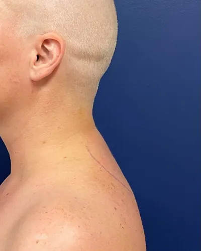 Liposuction Case #9534 — after, Dr. Frank Albino