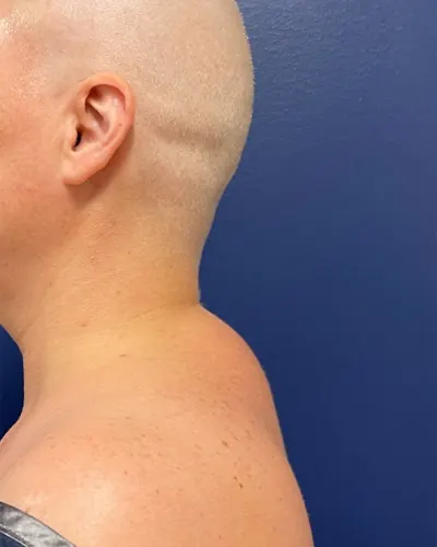 Liposuction Case #9534 — before, Dr. Frank Albino