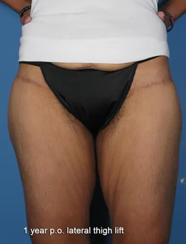 Thigh Lift Case #75 — after, Center for Plastic Surgery