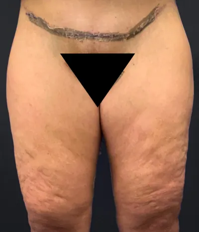 Thigh Lift Case #2024 — after, Dr. Arjun Kanuri