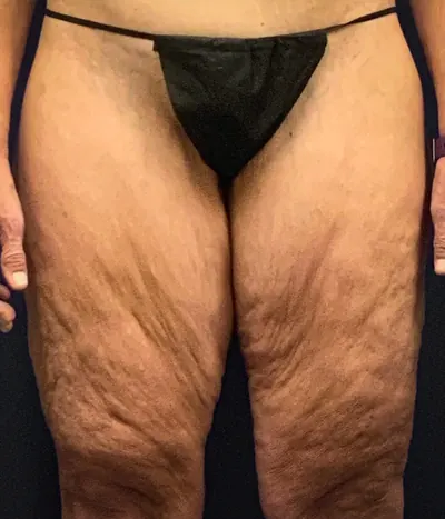 Thigh Lift Case #2024 — before, Dr. Arjun Kanuri