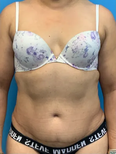 Tummy Tuck Case #25988 — after, Dr. Arjun Kanuri