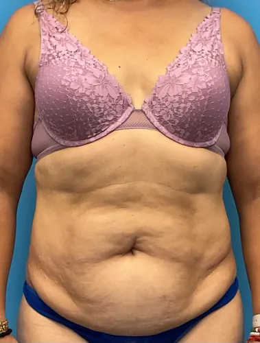 Tummy Tuck Case #25988 — before, Dr. Arjun Kanuri