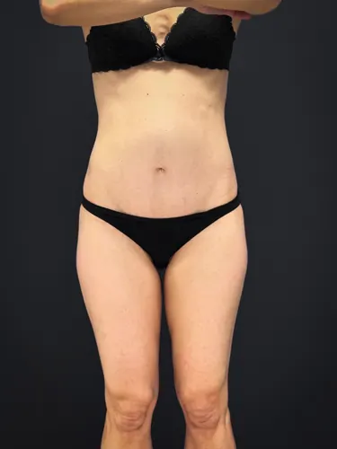 Tummy Tuck Case #2729 — after, Dr. Samir Rao