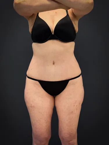 Tummy Tuck Case #7170 — after, Dr. Samir Rao