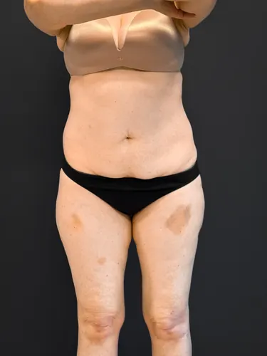 Tummy Tuck Case #7170 — before, Dr. Samir Rao