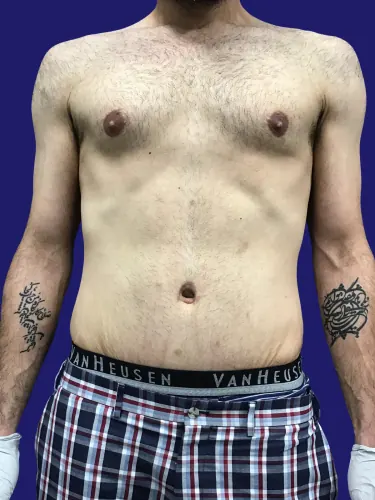 Tummy Tuck Case #1074271 — after, Dr. Frank Albino