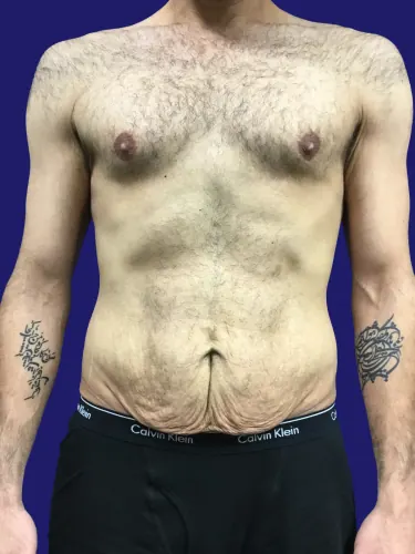 Tummy Tuck Case #1074271 — before, Dr. Frank Albino