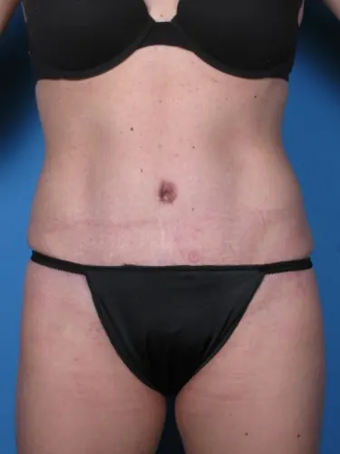 Tummy Tuck Case #250 — after, Dr. Samir Rao