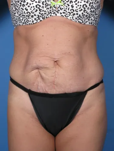 Tummy Tuck Case #250 — before, Dr. Samir Rao